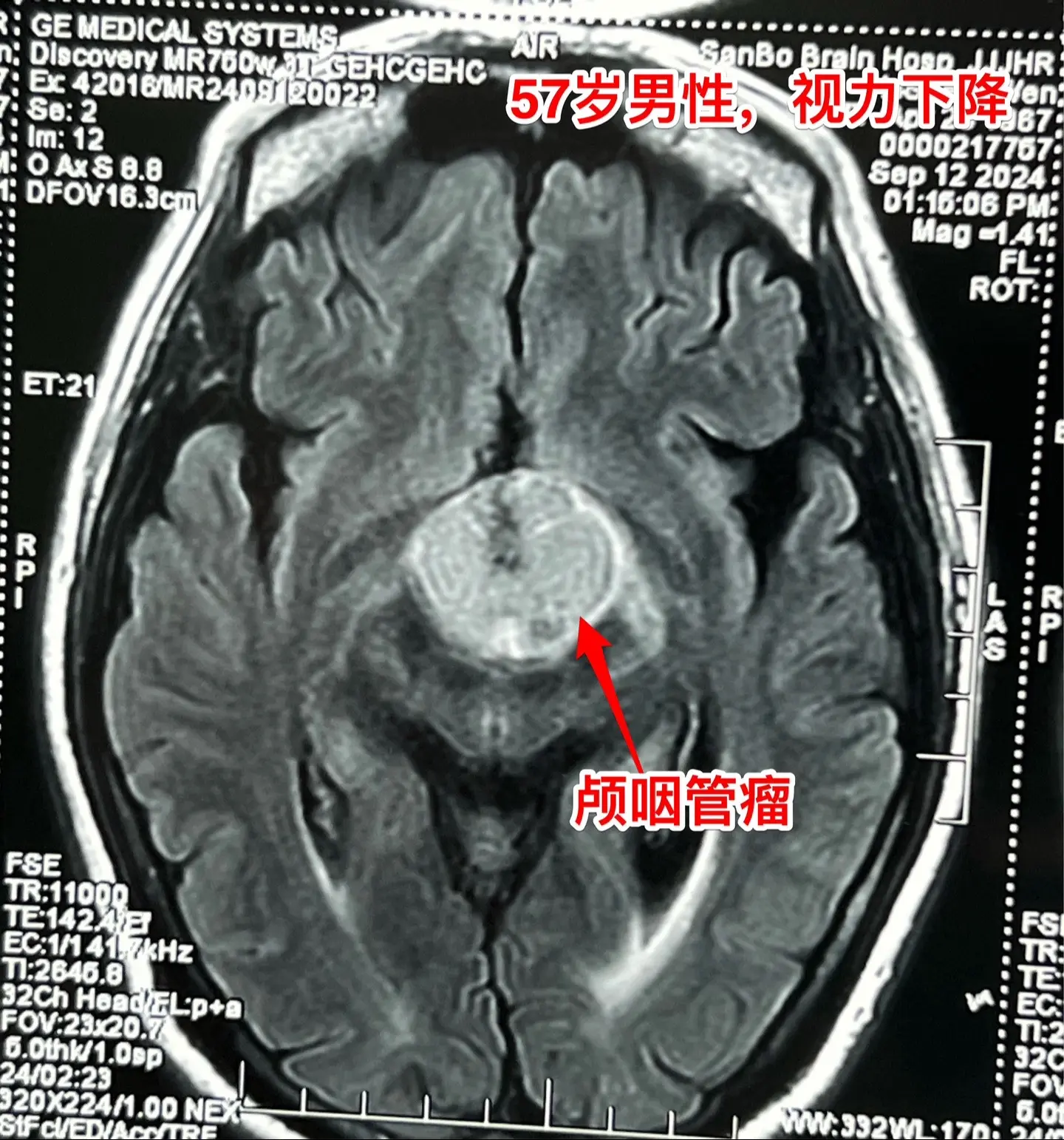 57岁男性，颅咽管瘤导致视力下降。病人因视力下降、消瘦到外院检查发现颅...