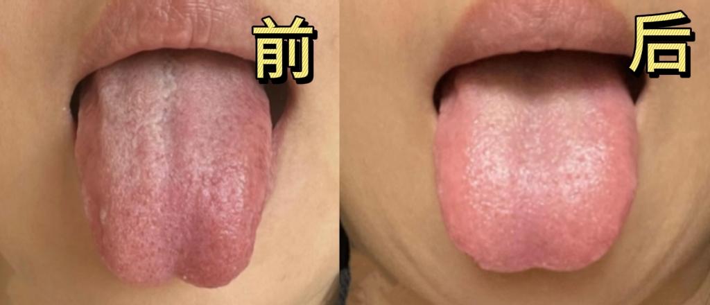 多年淤血舌，一个疗程不到，舌色逐渐转亮，瘀点淡化，心气也明显回升。
很多人看到“