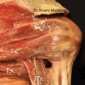 肩袖损伤 前两天有朋友咨询，肩膀手术的康复，今天给大家详细讲讲——肩袖撕裂到底是