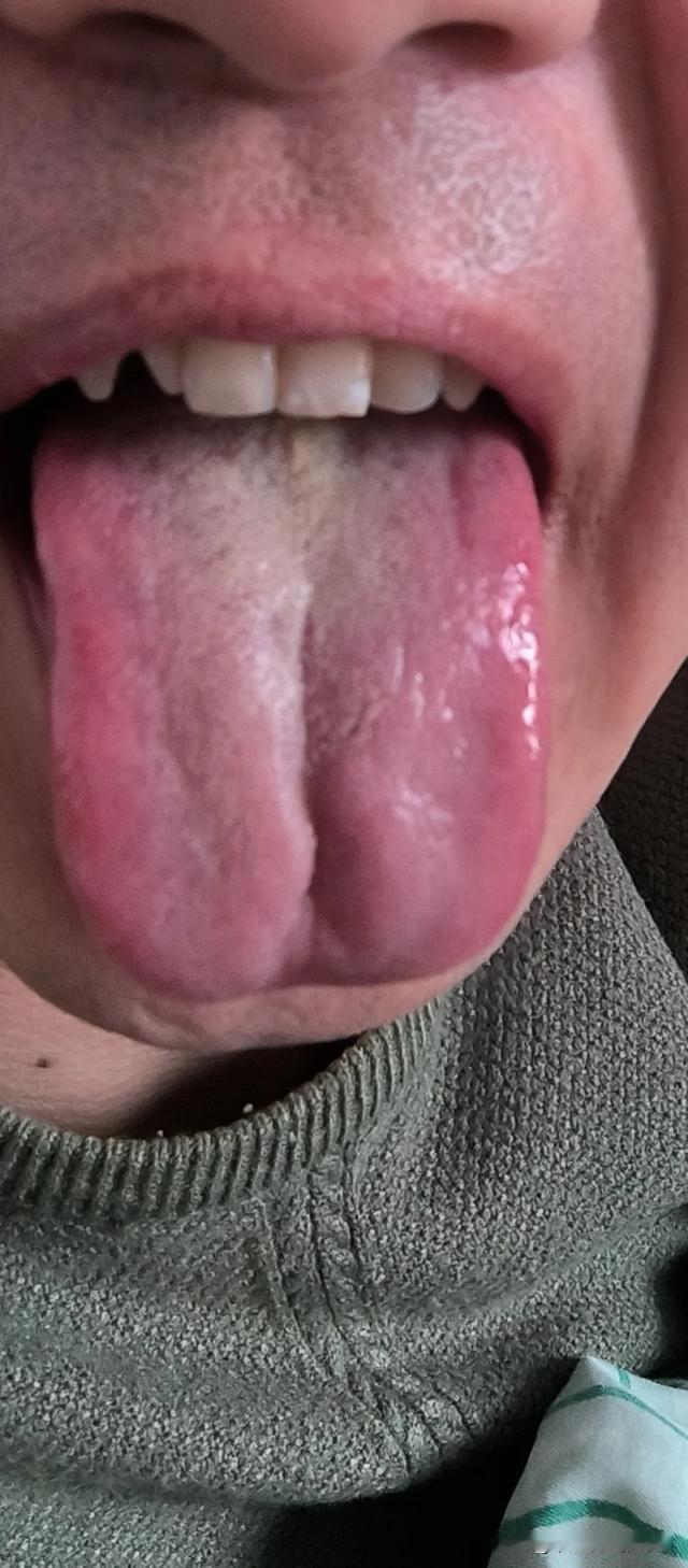 说了先不让补，先不让补，就是不听，这下好了，棘手的很[发怒][发怒][发怒]
粉