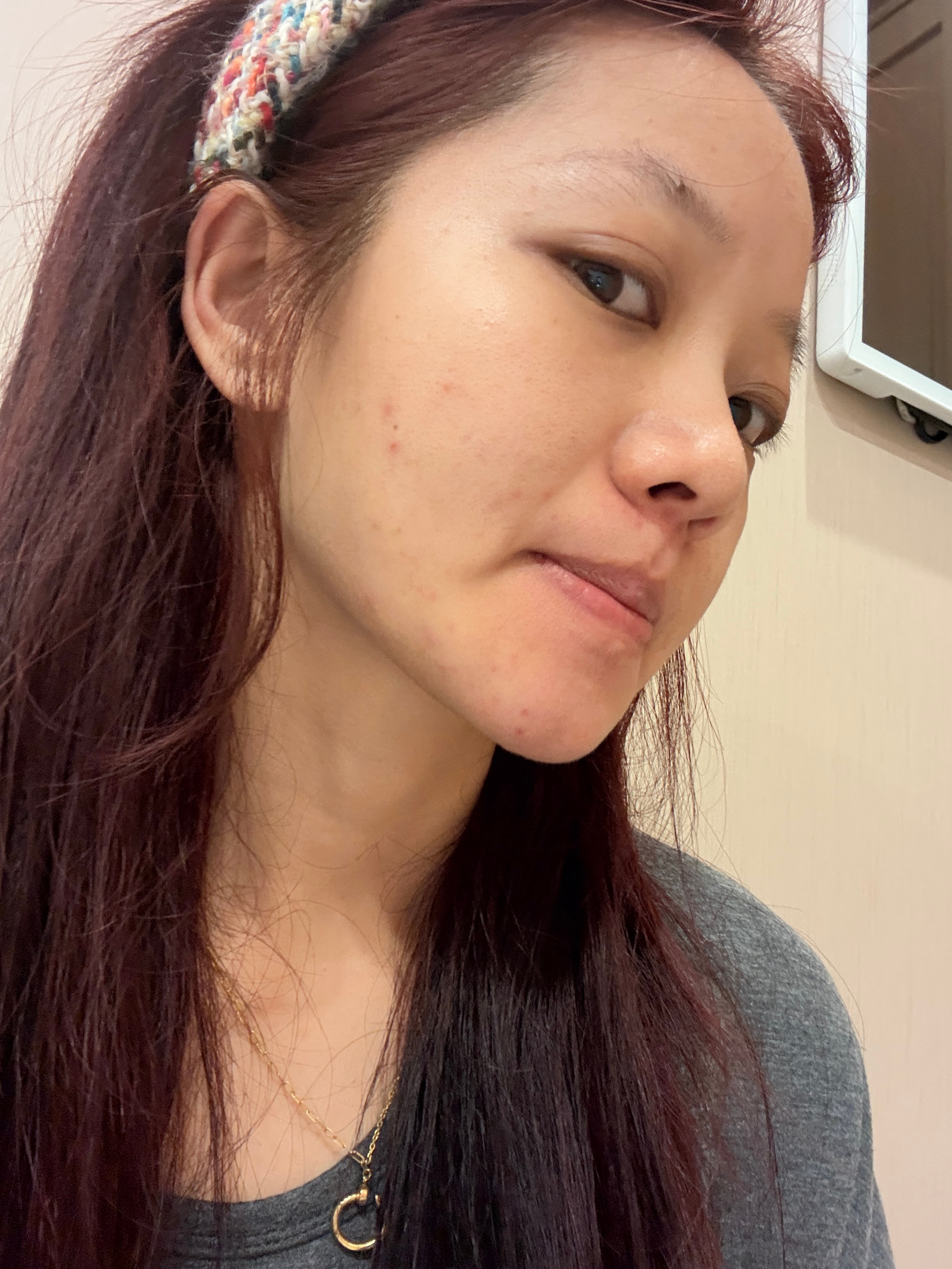 也不知道是不是吃中药的原因 药是中午吃的 痘是晚上长的晚上起来比昨晚睡前还重 你