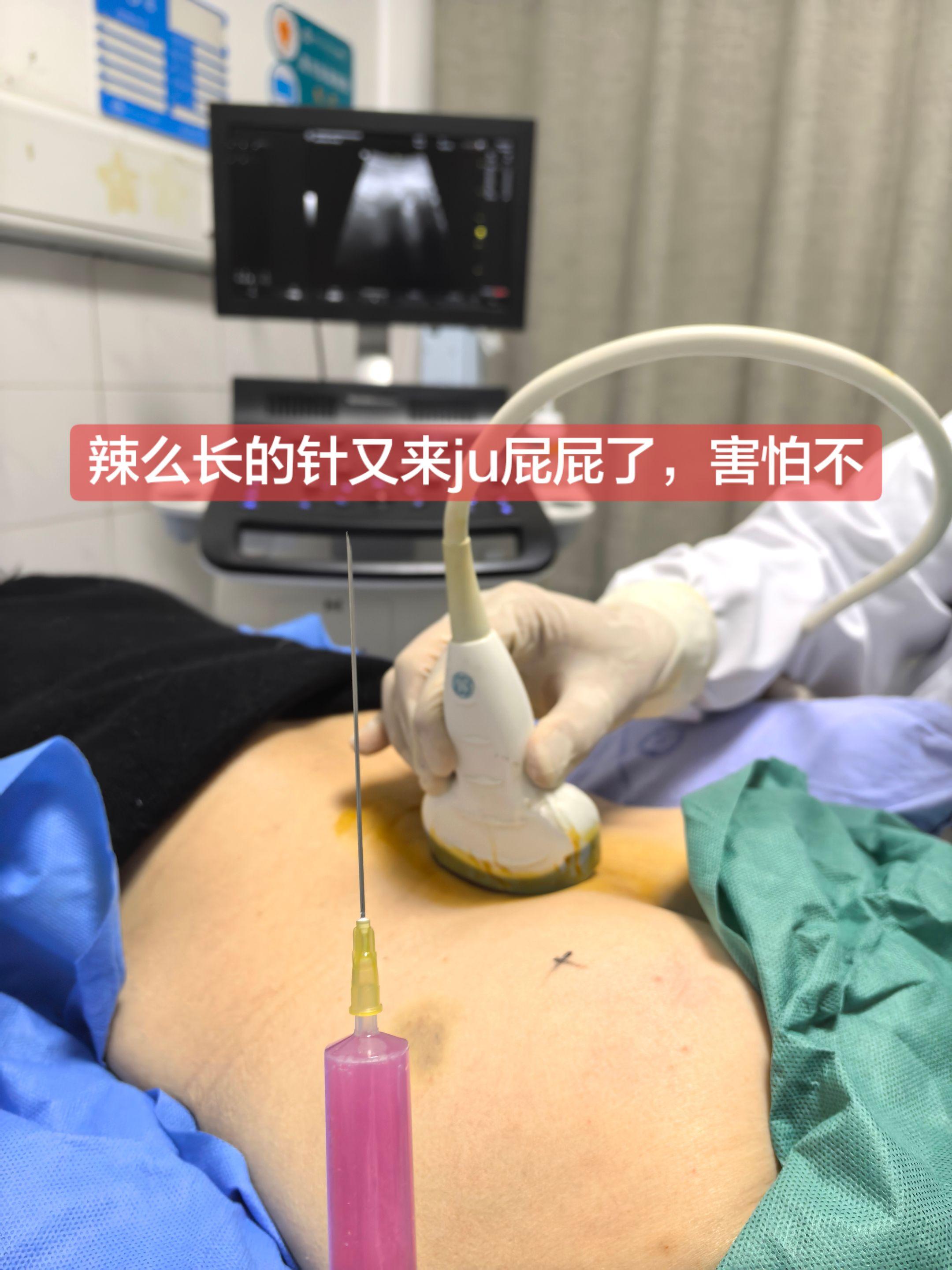 超声可视化腰椎间盘突出+梨状肌阻滞治疗