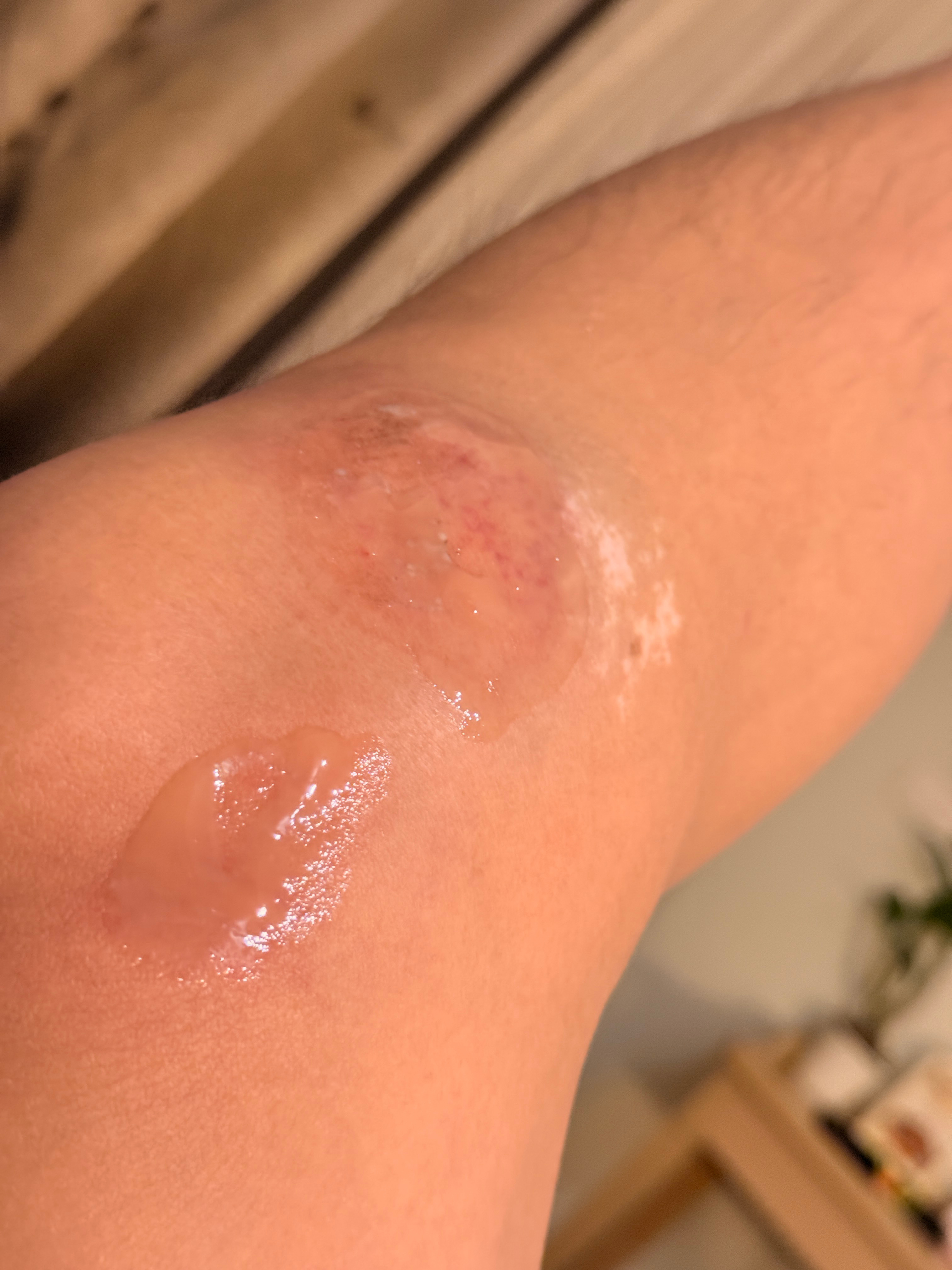 泰国买了个擦伤的药，抹上去我直接尖叫……超级疼，吓死了。 