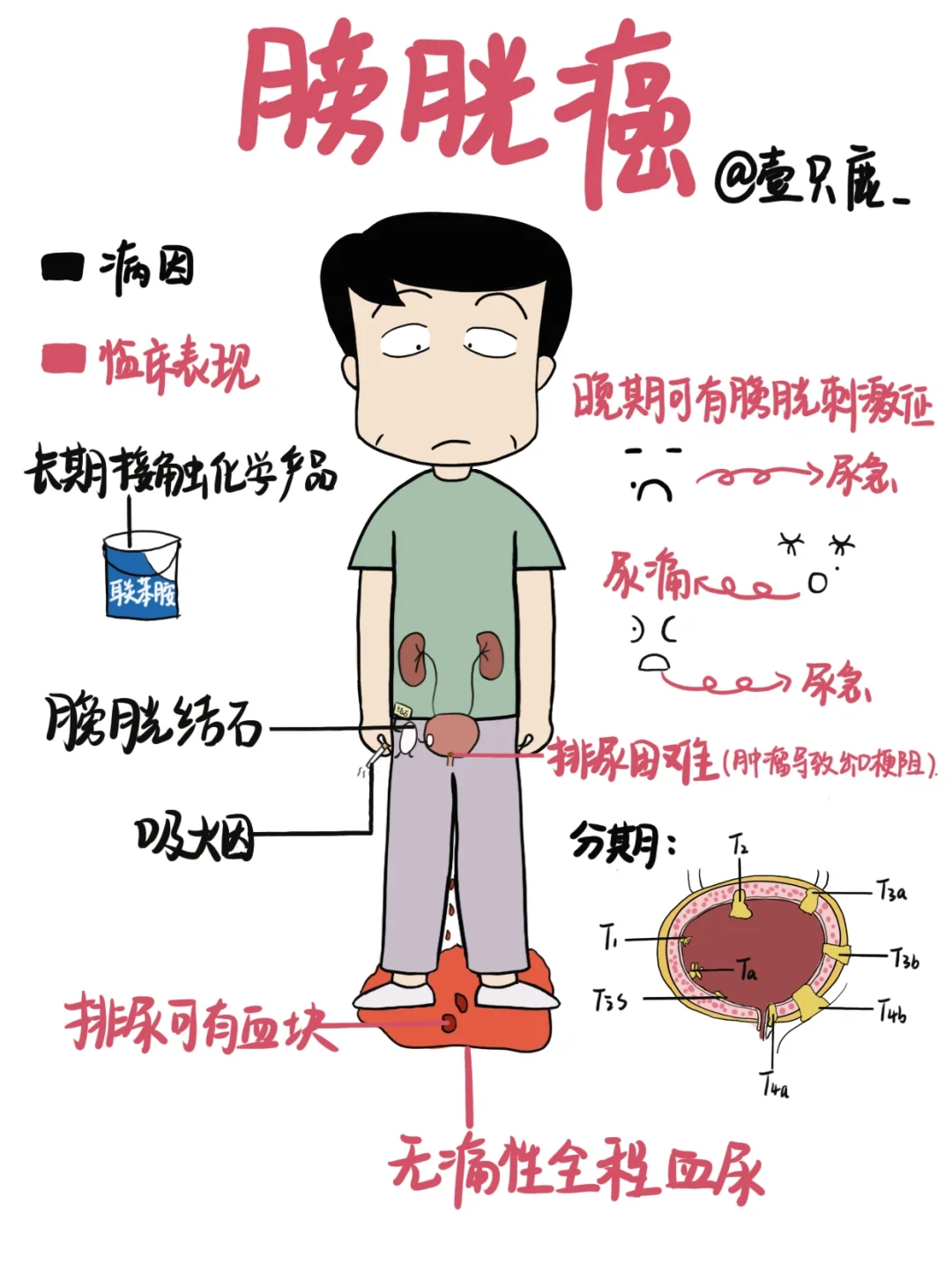 医学生笔记📒｜膀胱癌🧐