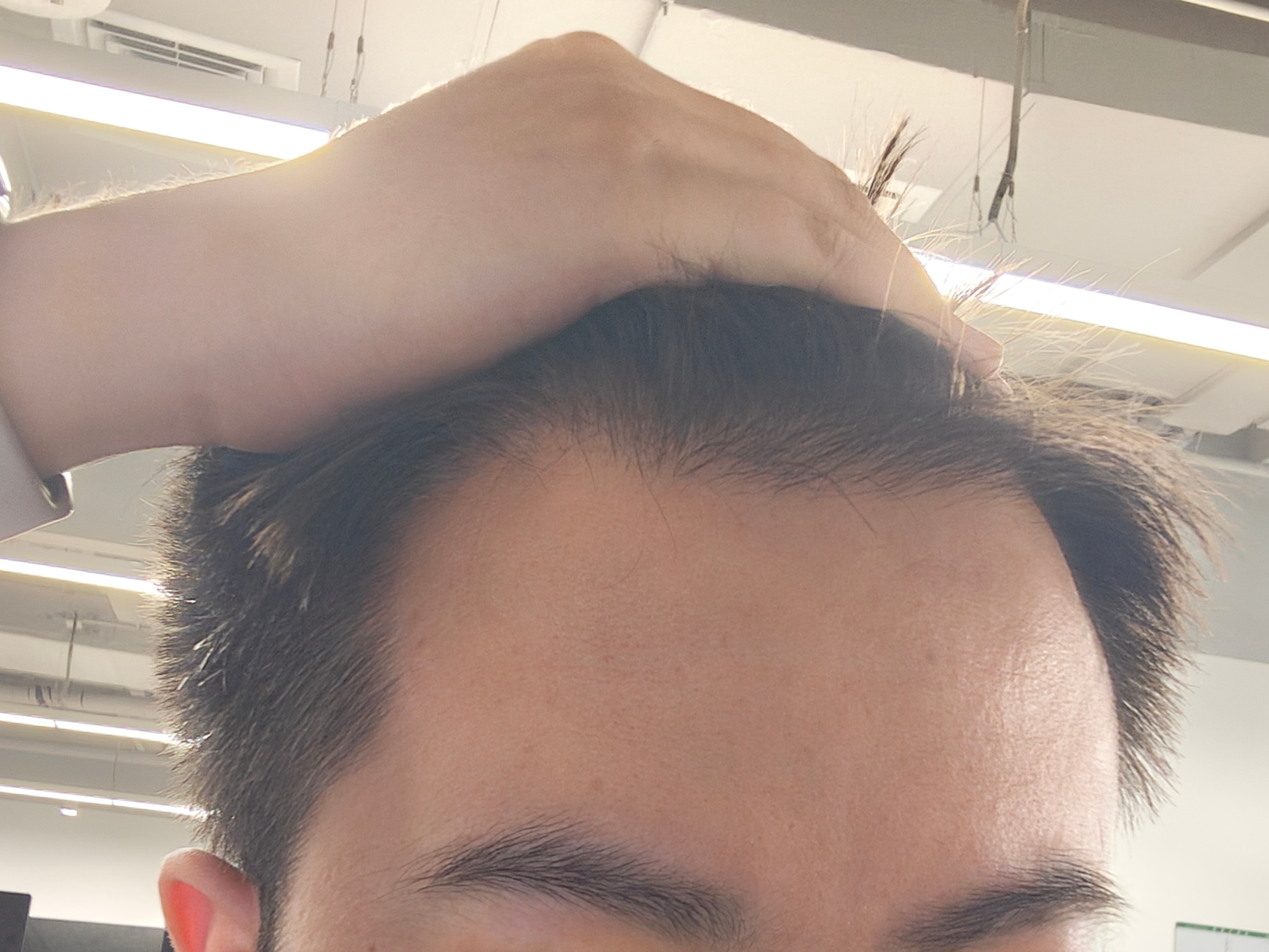 男性雄脱黄金搭档非那雄胺+米诺地尔，内服+外用双管齐下至少半年以上，我小王要试试