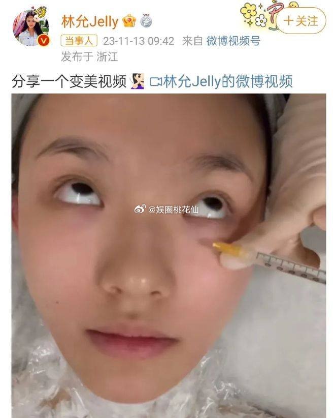 星女郎林允大胆公开打水光针过程，网友：为炒作太拼太狠。此次的分享引发了网友们的热