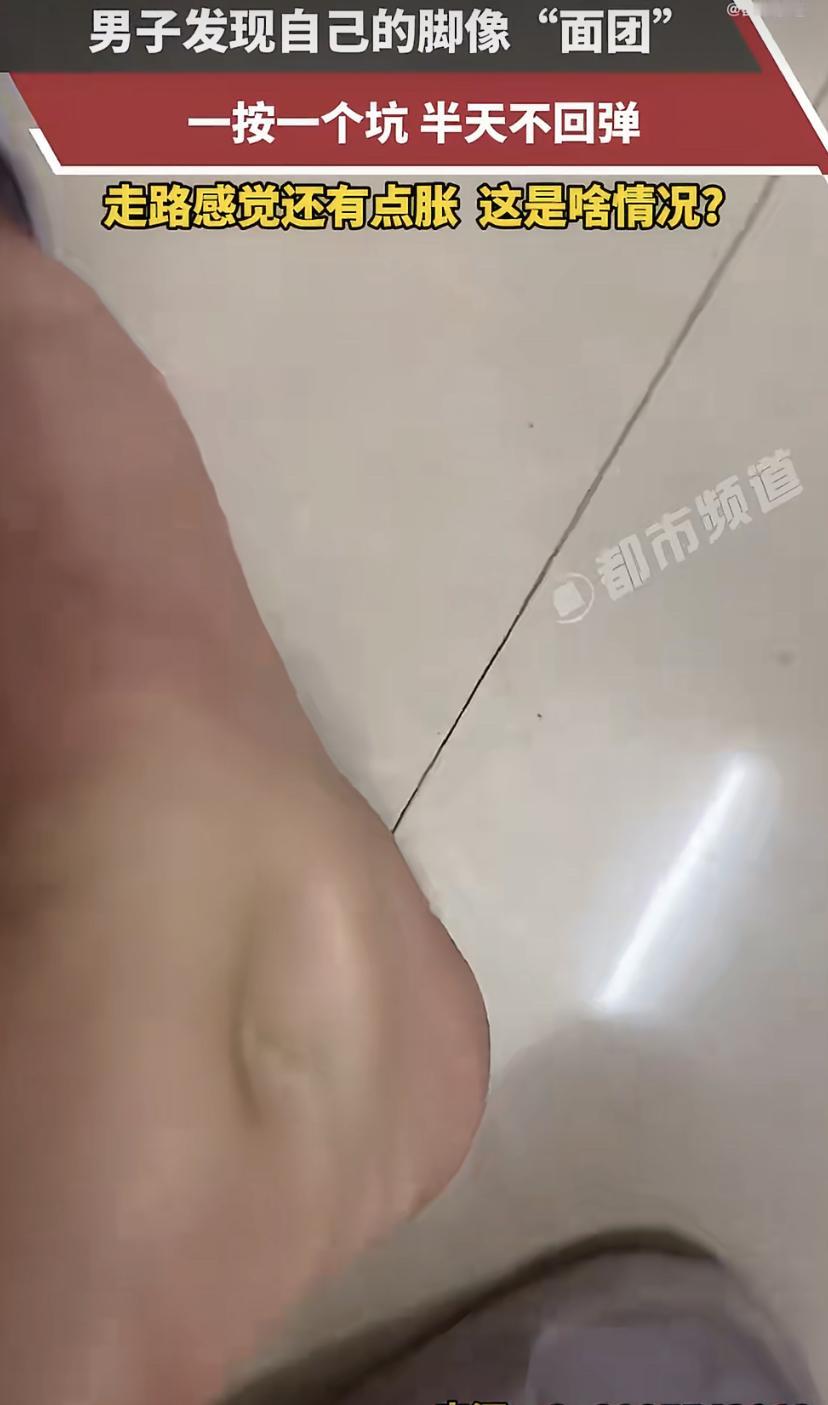 广东一个外卖小哥，跑完单发现脚肿得像发面馒头，手指一按一个坑，半天不回弹，走路还