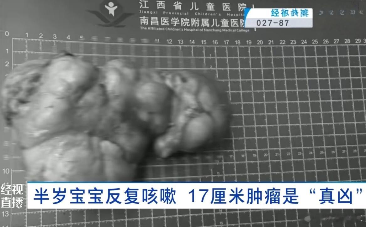 半岁宝宝反复咳体内取出17厘米巨瘤我的天呐，看着也太吓人，这也太遭罪了 ​​​