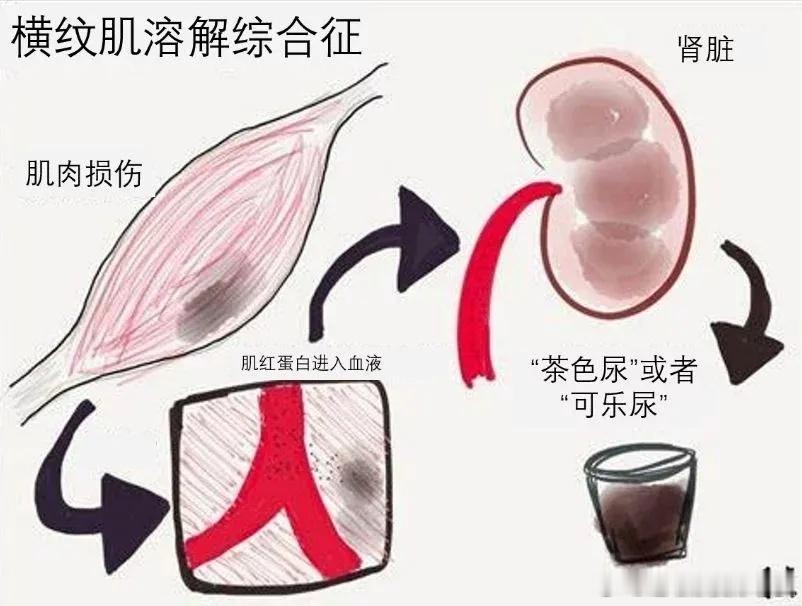 #女子每天1小时动感单车致横纹肌溶解# 再一次看到了这样的新闻[跪了]朋友们运动