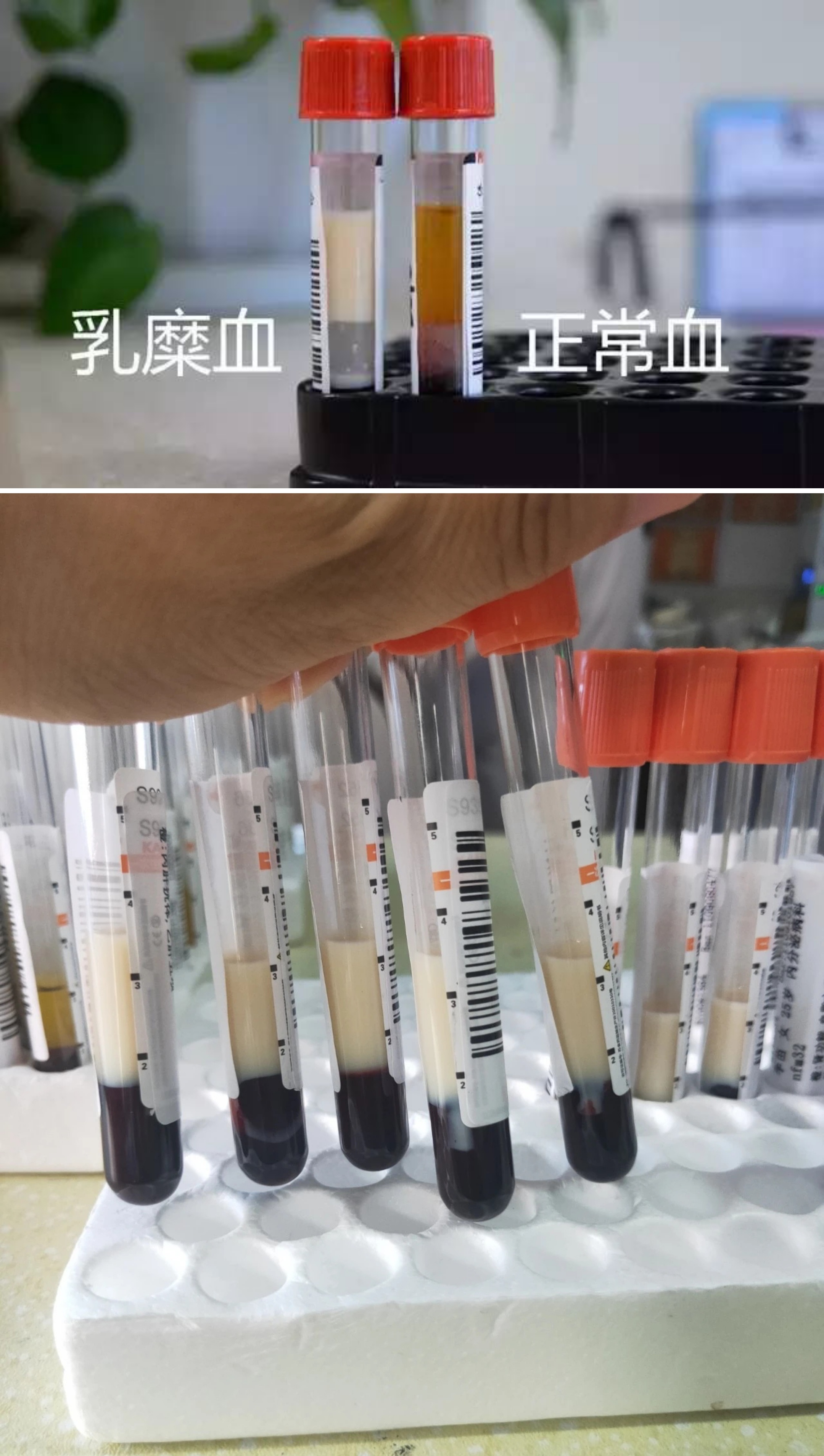 #你的血管里流的不一定是血#这叫“乳糜血”，血清里的水分被不溶性乳糜微粒取代了。