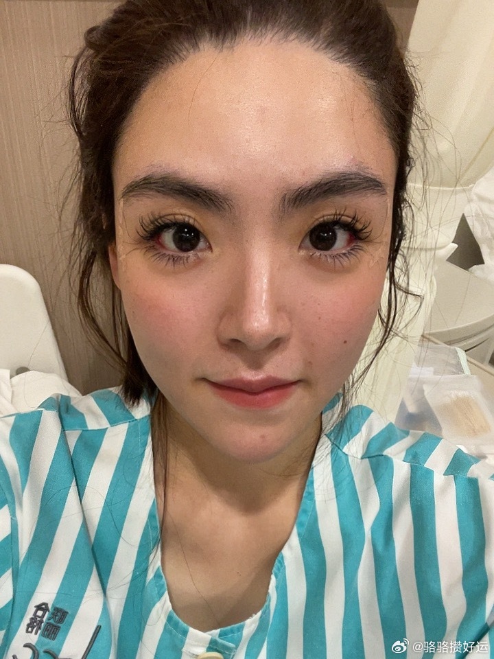 斗鸡眼大变身：骆骆苦心专研6年，实践出真知。首先声明一下，我这类斗鸡眼通常不是眼