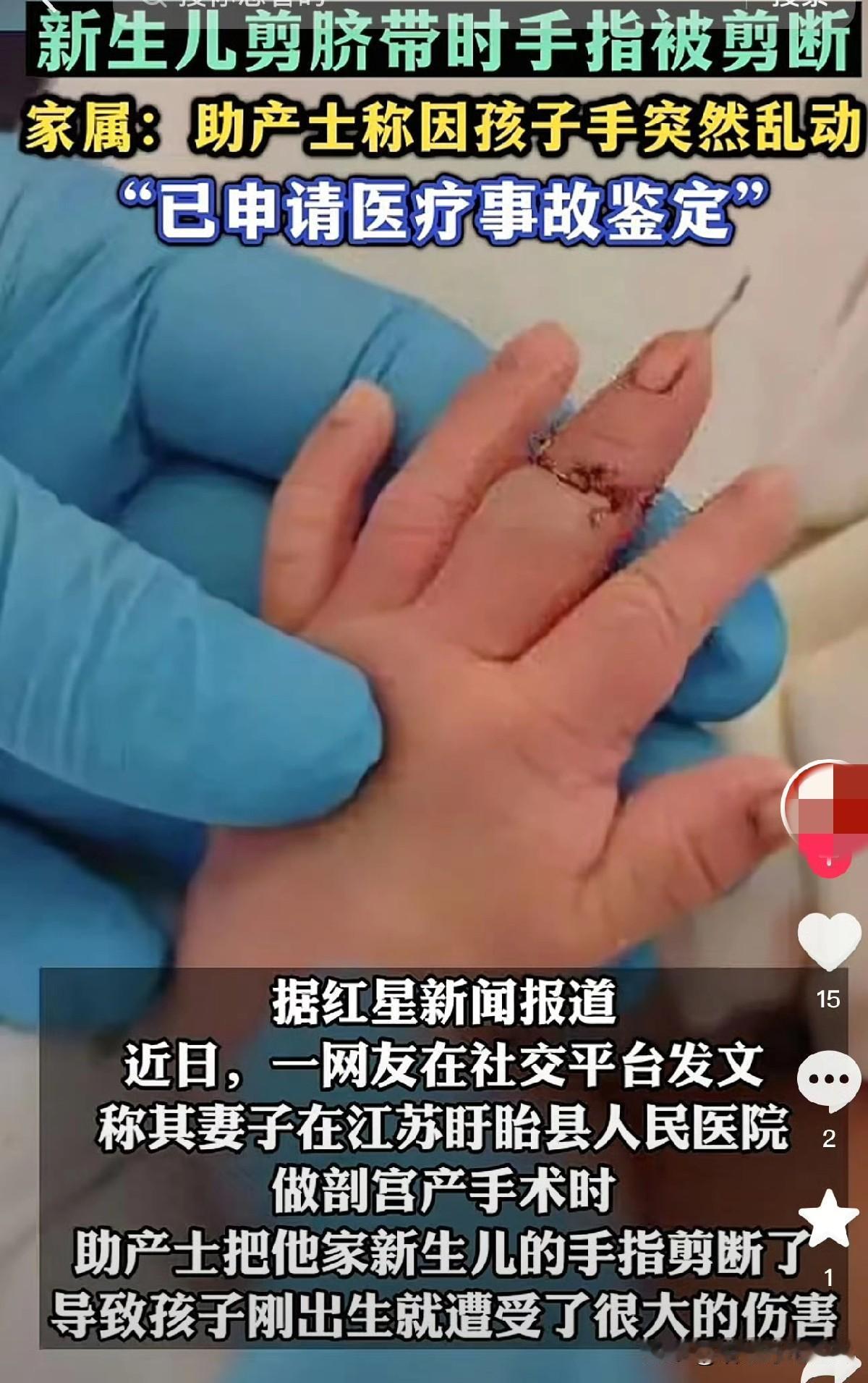 若事件属实，令人既心碎又震怒……
剪脐本是产房最常规的操作之一，如此低级差错本不