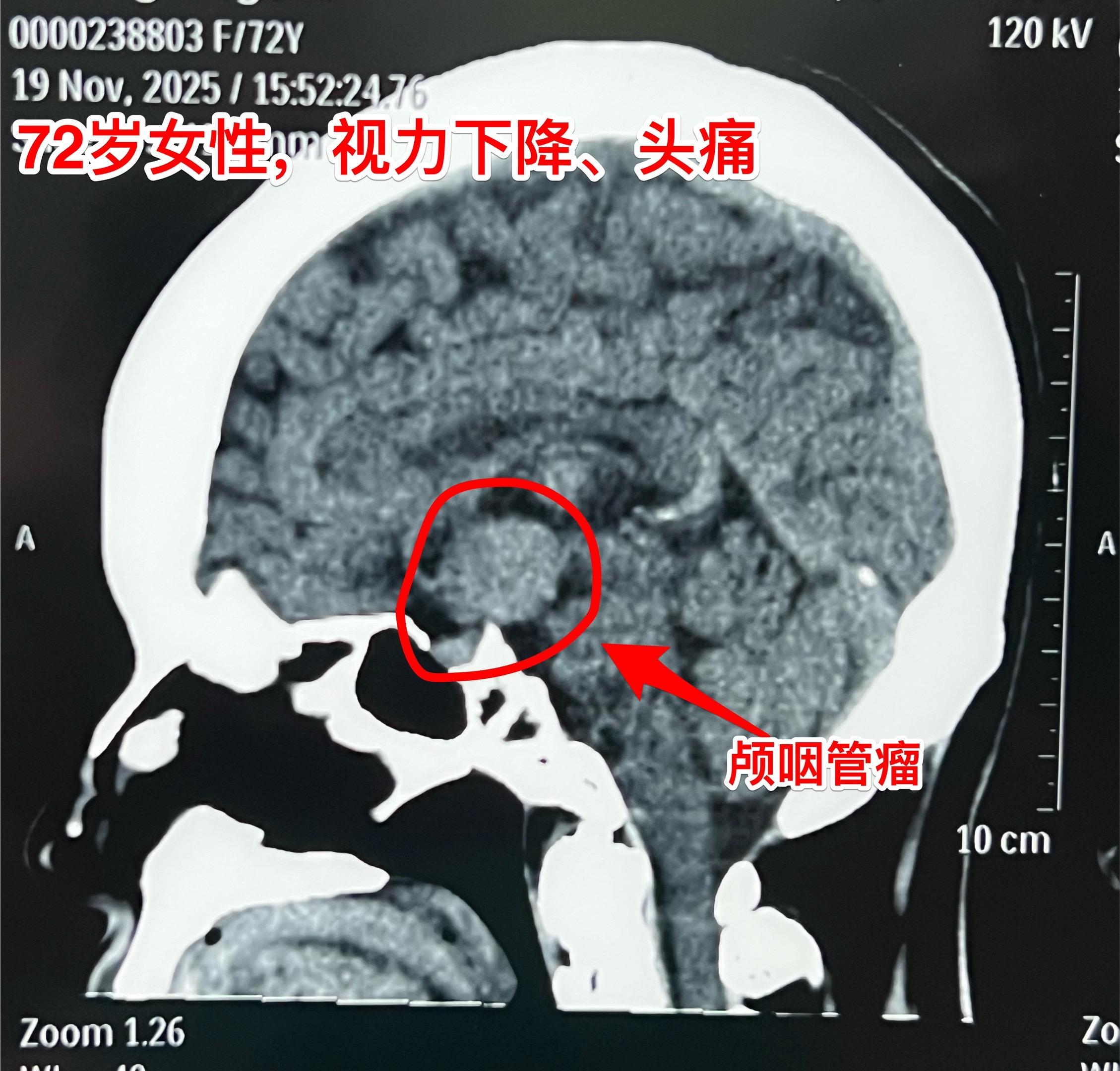 颅咽管瘤可以在任何年龄发病。72岁老人也患颅咽管瘤！        很...