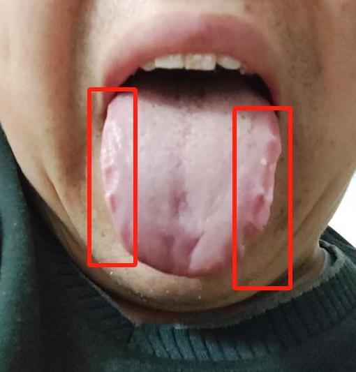 齿痕舌是小事，拖半年以上的，可真是大事啊！[泣不成声]
29岁年轻帅哥，知道自己