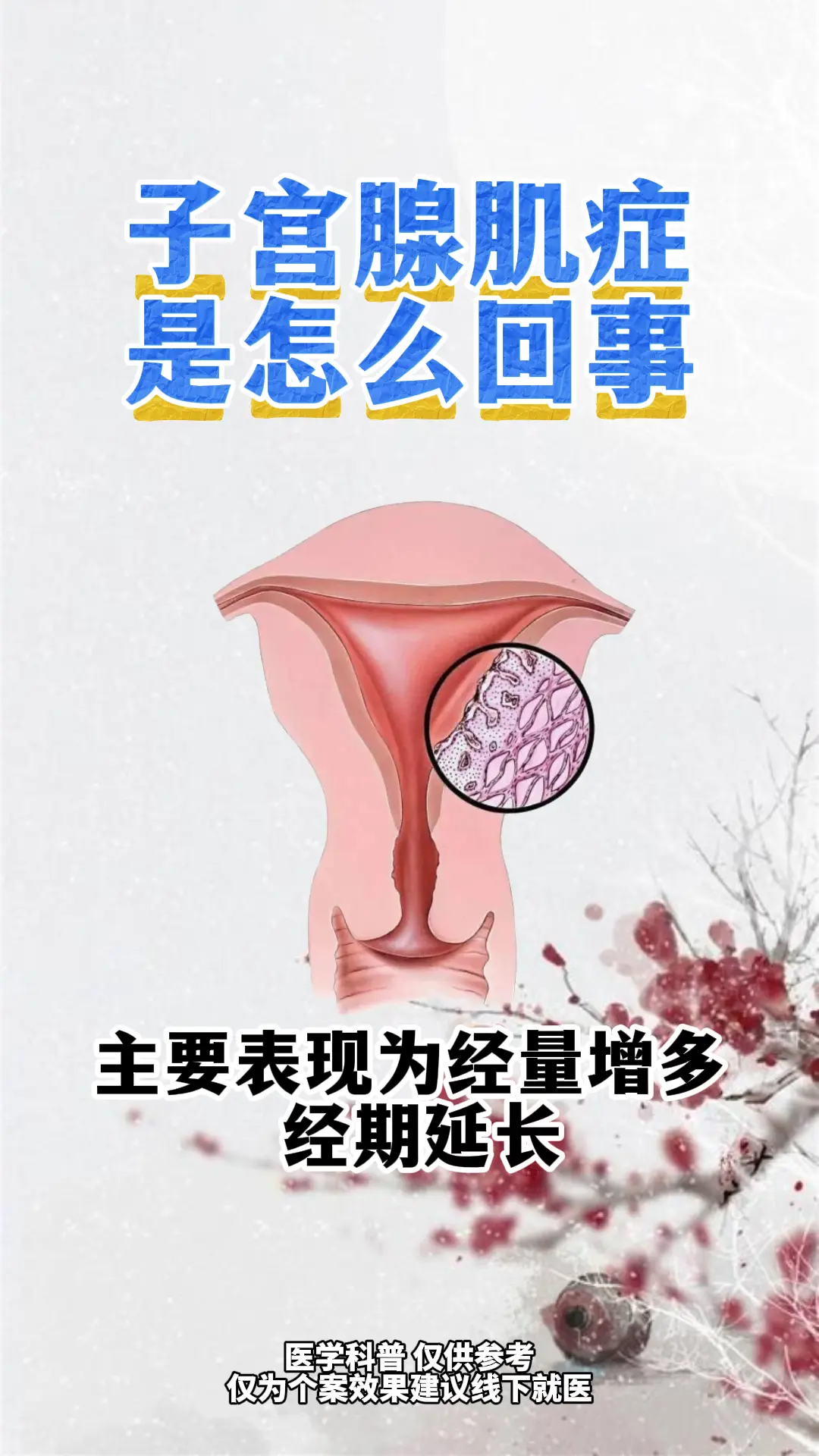 子宫腺肌症怎么回事。