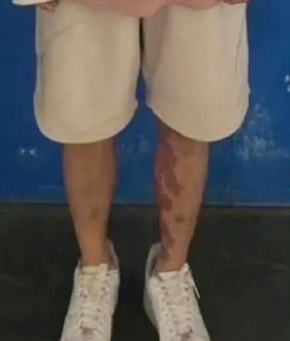星星腿上的是胎记 诶呀妈呀吓我一大跳，我差点阴谋论都出来了[泪][泪][泪] 