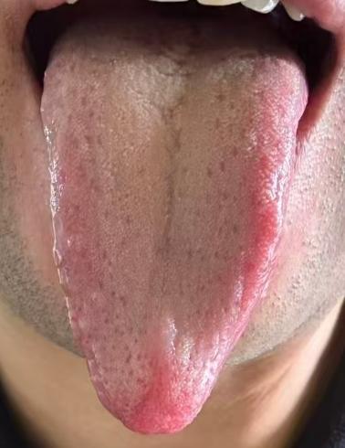 身体反复不适难恢复？一文看懂男性阴虚湿热辨证要点







很多年轻粉丝问我