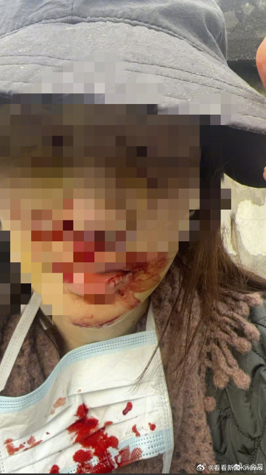 【#金晨发车祸时照片#】1月30日，发文就网上流传的消息说明并致歉，她还在评论区