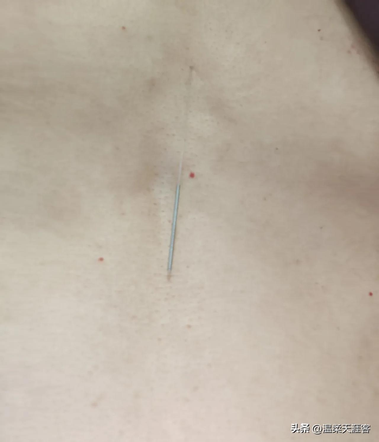 这哥们赚了！[笑哭]

做了针灸回到家，
他感觉胸前有东西，
看了一下还有个针忘