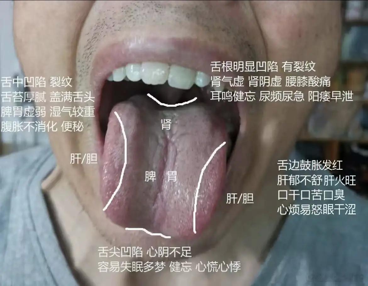 【粉丝舌象分析：口苦口臭，敏感不坚，心慌失眠】1、舌尖凹陷，舌质淡：说明心气血不