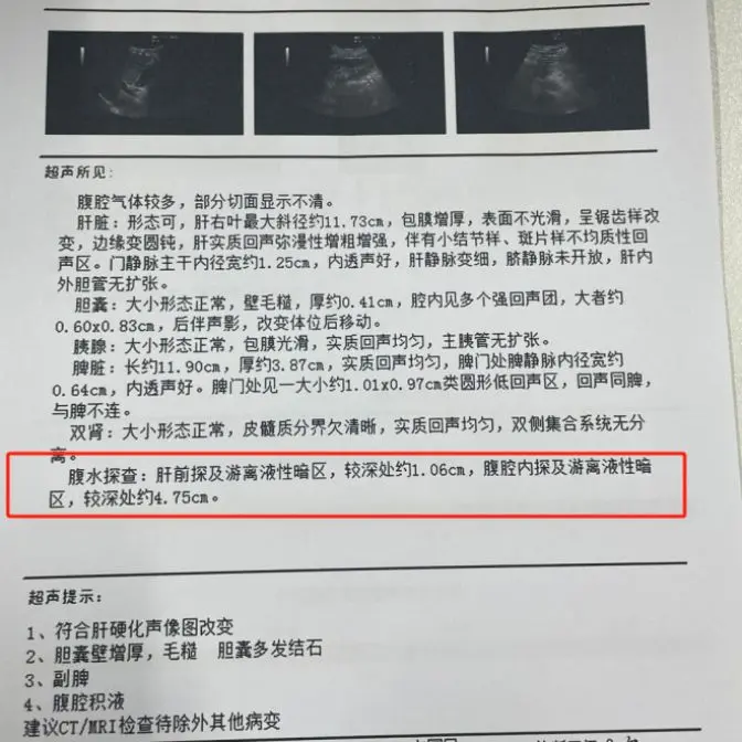 今天接了一位菏泽来复查的老患者，之前经过积极综合调理，腹水消除，情况得...