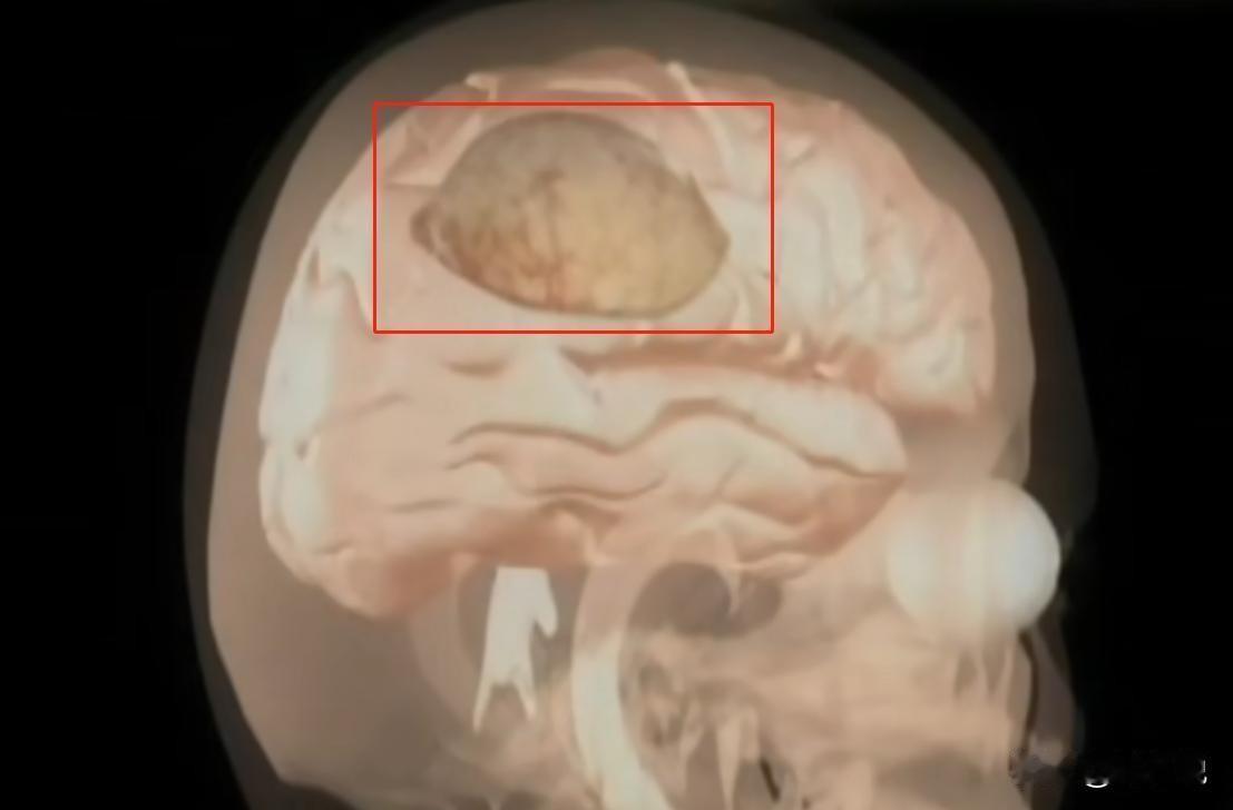 2007年，重庆一14岁男孩，莫名抽搐、学狗叫，医生竟从他的头颅里取出一个贝壳，