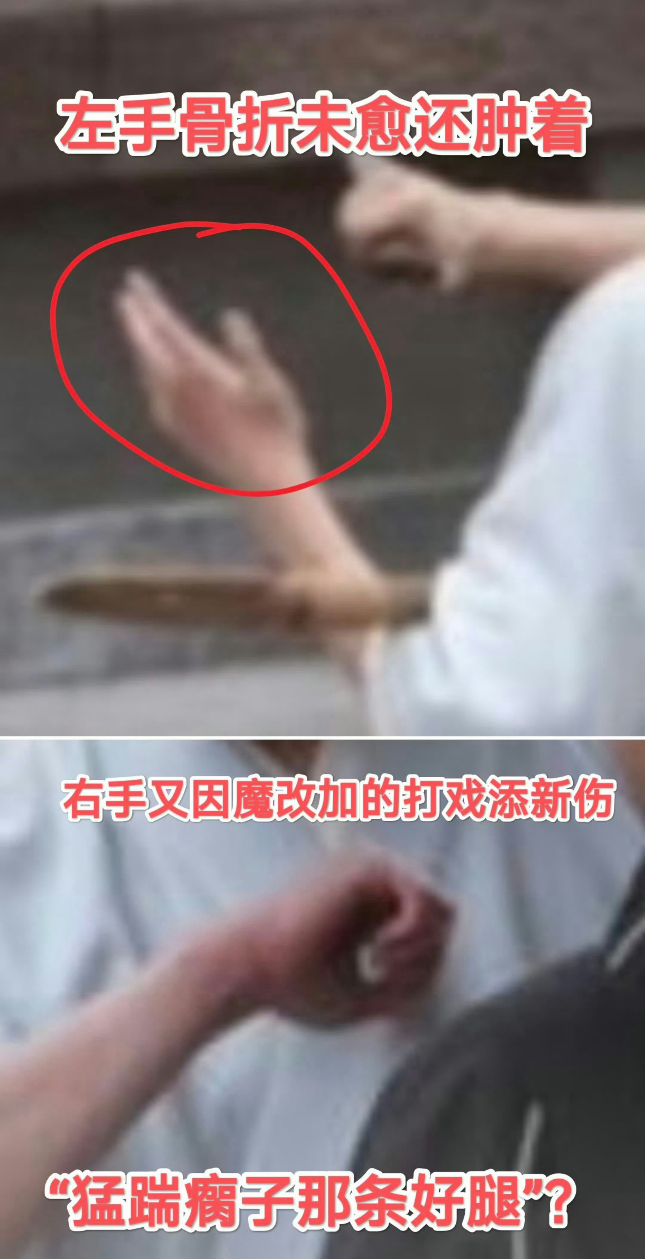 杨洋手部又受伤了开机的时候手部骨折，现在粉丝说右手又添了新伤，要求不让江山剧组赶