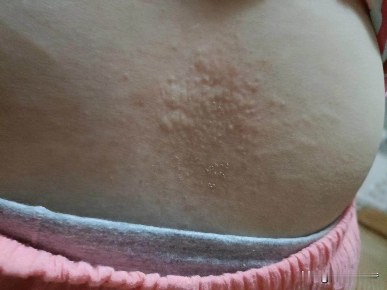 腰后面越来越氧，用了2天炉甘石还没好，这是什么？