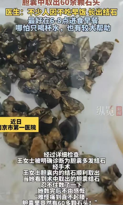 太吓人！3月3日，南京35岁女子聚餐后肚子剧痛，去医院一查，医生从她体内取出这玩