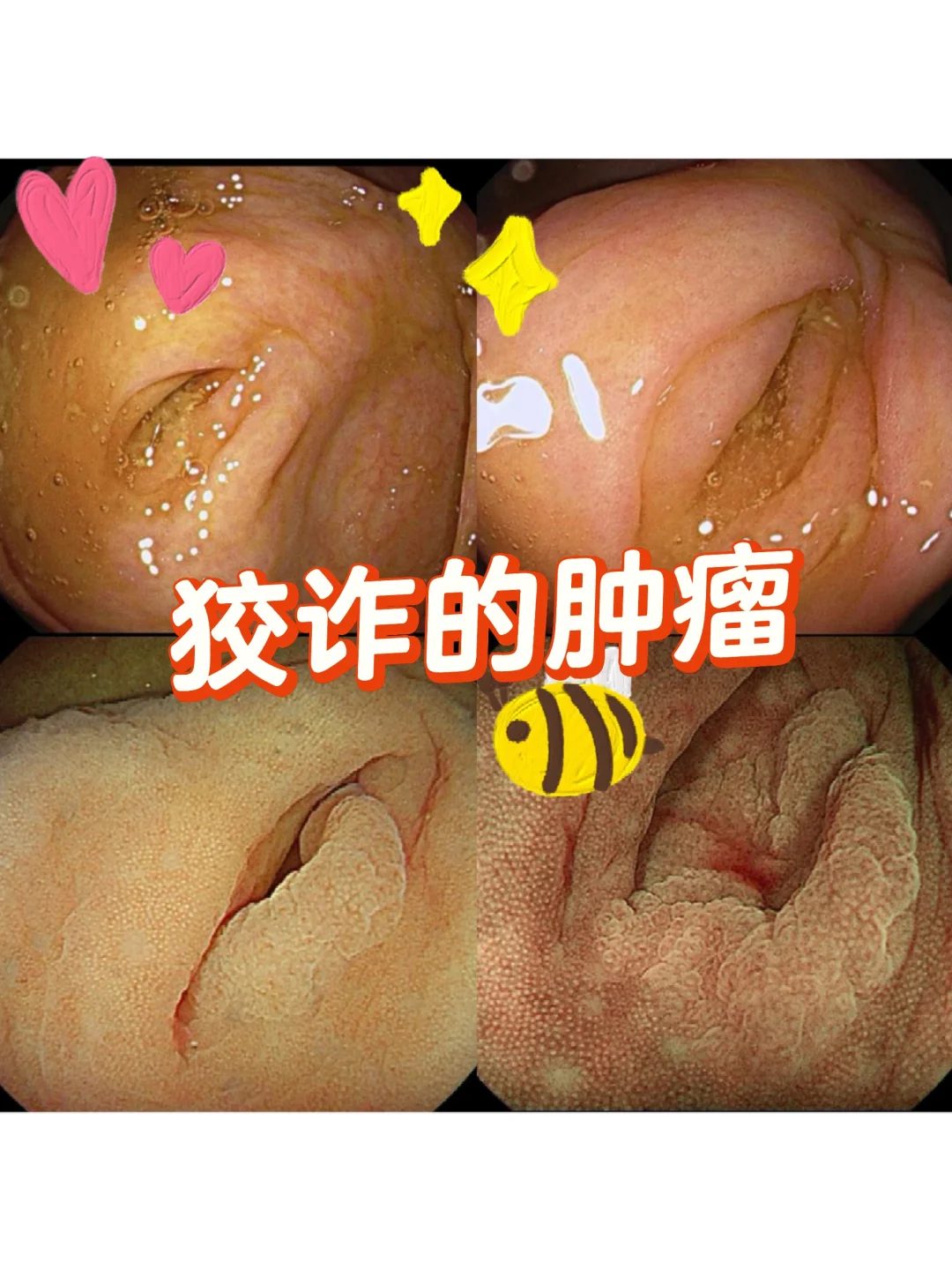 “狡诈”的肿瘤，净藏着掖着🥸🥸
