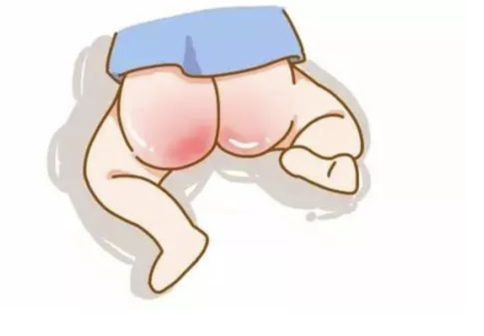 其实导致宝宝“红屁股”并不是纸尿裤，而是宝宝的尿液和大便对宝宝幼嫩肌肤的长时间的