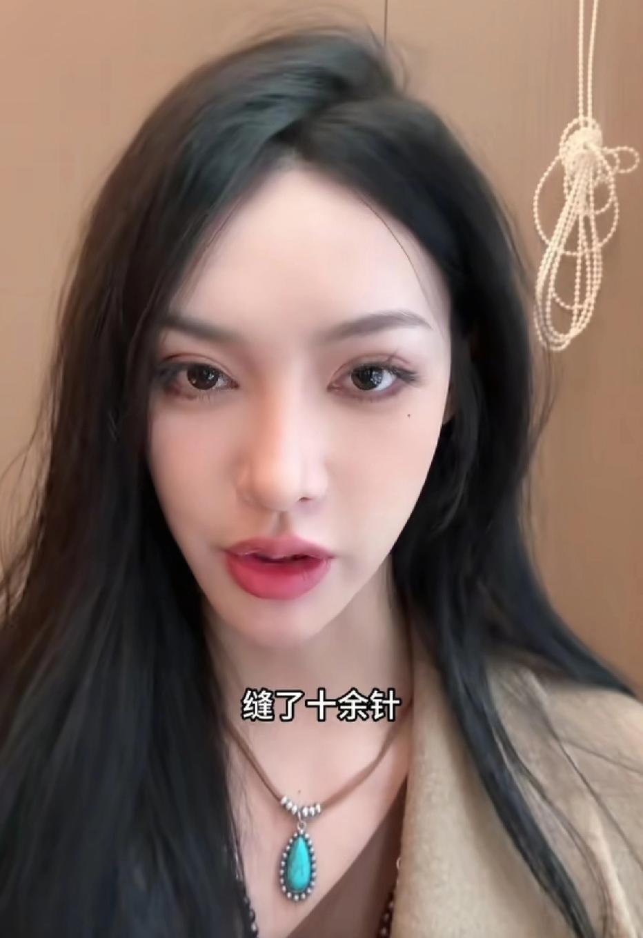 女子与闺蜜发生争吵，被闺蜜持菜刀砍伤头部，伤口缝了十针，而闺蜜仅被拘留十天。
