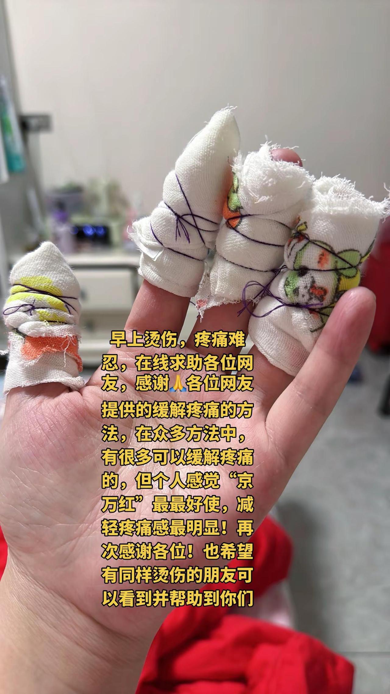 早上烫伤，疼痛难忍，在线求助各位网友，感谢🙏各位网友提供的缓解疼痛的方法，在众