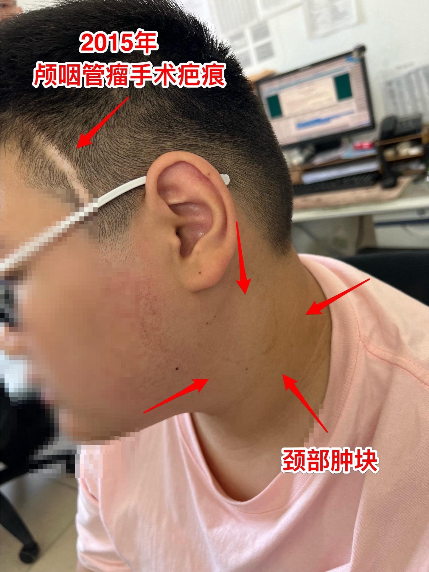 颅咽管瘤手术后9年，左侧颈部出现肿块。这周，一个来自焦作市的18岁年轻人来三博脑科医院复查，他在2015年在我这里作了颅咽管瘤切除手术，这些年多次复查磁共振都没有发现颅咽管瘤复发。
       但是近期他的左侧耳朵下方颈部出现肿块，见图。在外院做了肿块穿刺活检，病理报告见图，报告怀疑是“粘液表皮样癌”。病人和家长来找我，目的是让我来判断这个颈部肿块是不是颅咽管瘤转移到颈部的？
        我仔细看了最近的磁共振，原来的颅咽管瘤没有复发！而现在的颈部肿块是另一个肿瘤！不是颅咽管瘤！
       家长又