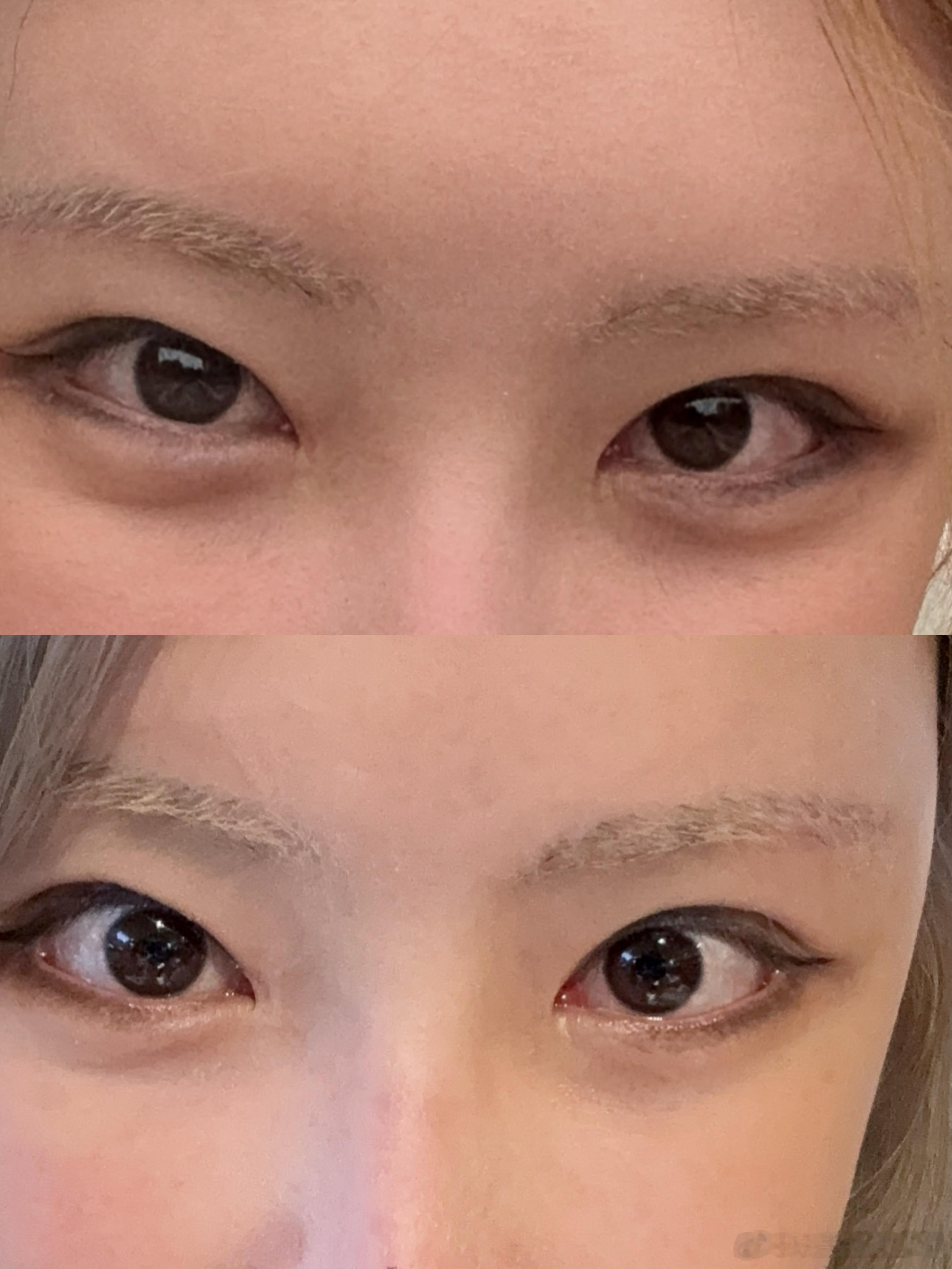韩国前VS韩国后，皮肤变好and眼睛变大。每次去都是大大修整，眼睛超声刀叠加眼皮