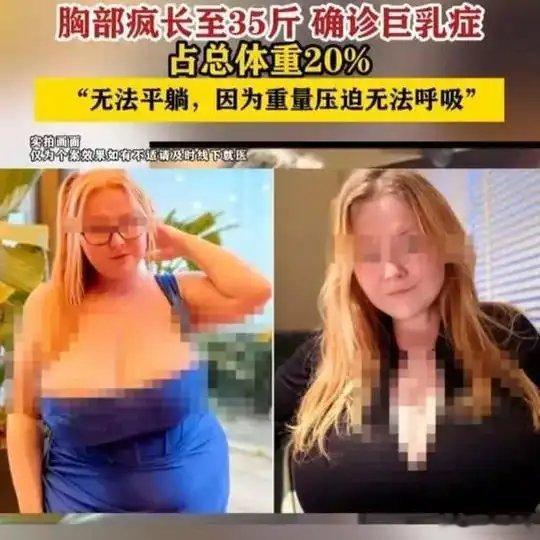 《「英国女子服减肥药后胸部疯长至35斤确诊巨乳症」》「英国女子服减肥药后胸部疯长