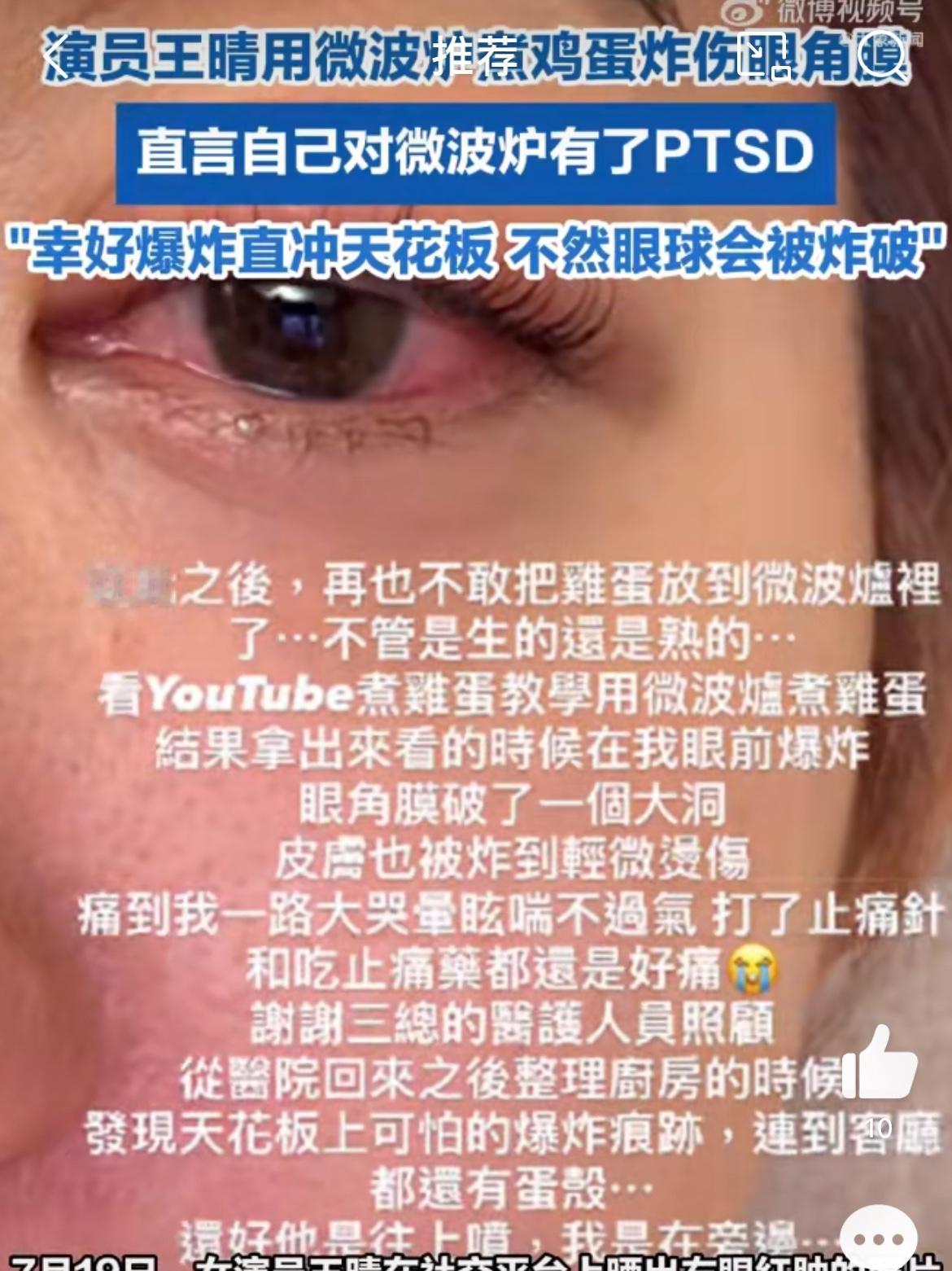 演员王晴微波炉煮鸡蛋，鸡蛋爆炸差点失明。她说是看了网上的视频教程，学着用微波炉煮