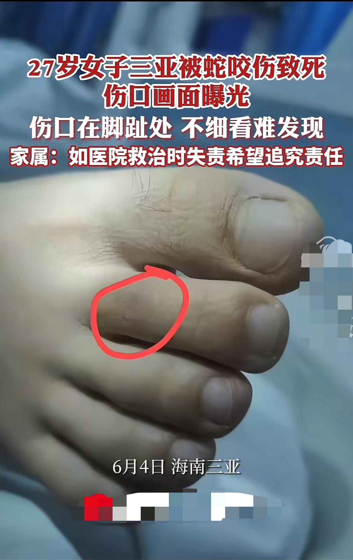 三亚这个被蛇咬伤致死的女子太可惜了，因为伤口在脚趾处，非常细小，不仔细查看真的无