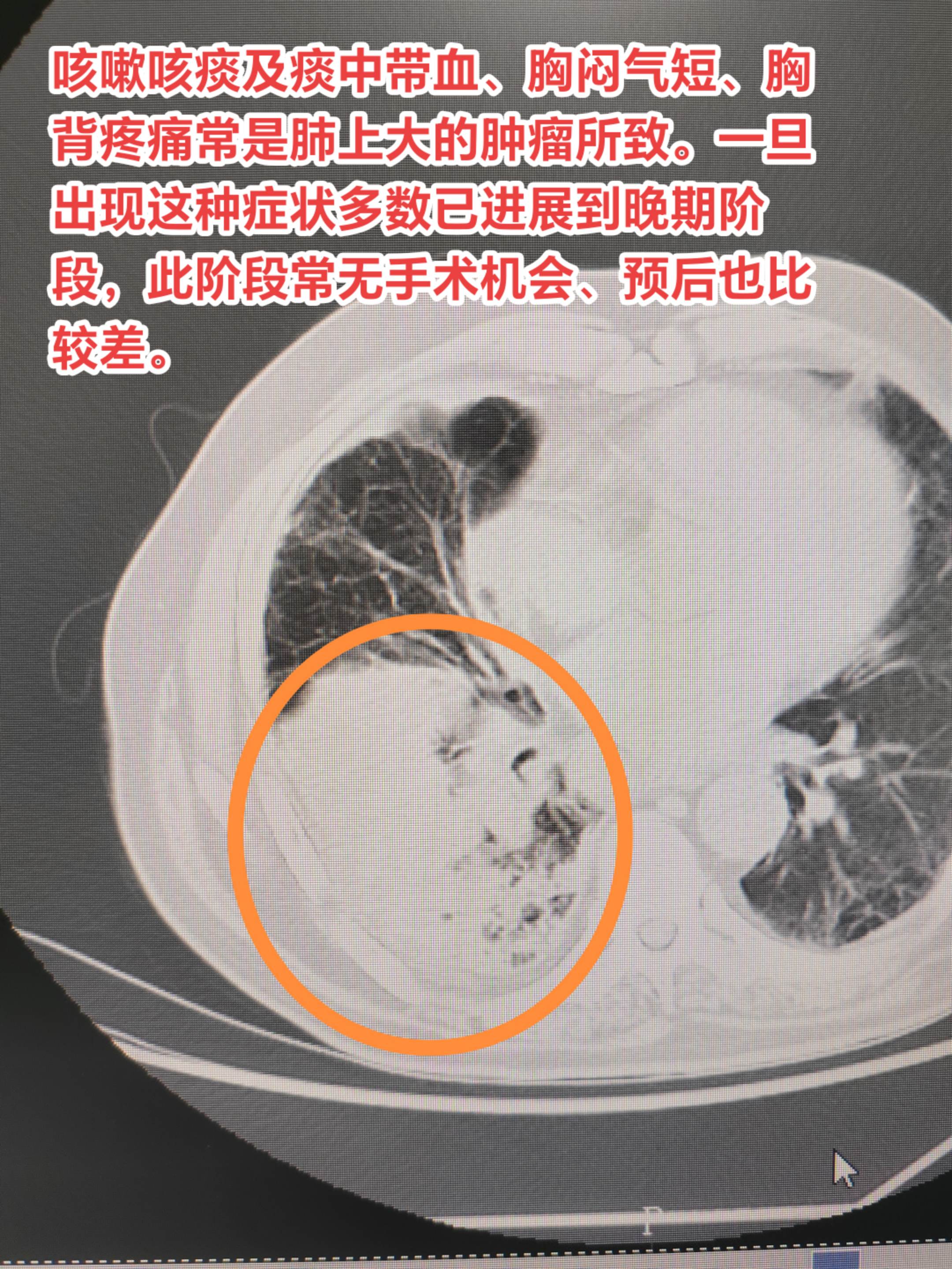 咳嗽咳痰、胸闷气短、胸背疼痛当心肺疾。咳嗽咳痰及痰中带血、胸闷气短、胸...
