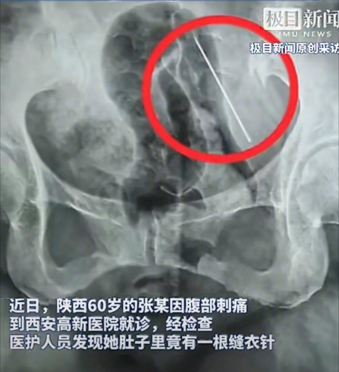 这根4厘米的缝衣针，扎进了60岁张阿姨的肚子，更扎醒了被温情忽视的老年安全隐患。