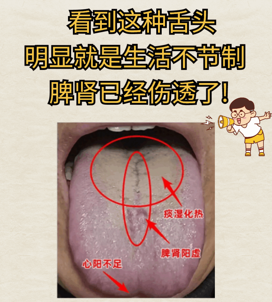 看到这种舌头，明显是生活不节制，脾肾已经伤透了