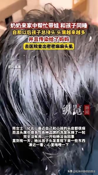 “太瘆人了！”浙江杭州的陈女士这段时间总觉得头皮奇痒，头屑掉个不停，换了好几种洗