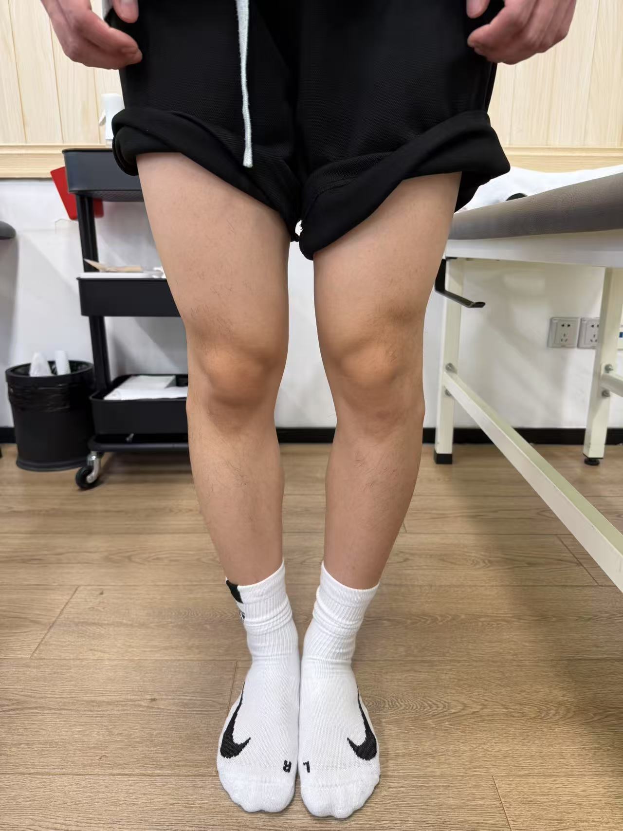 这是我们上海徐汇门诊一位患者的腿型，两条腿并不拢大家在日常生活中见过这种情况吗[