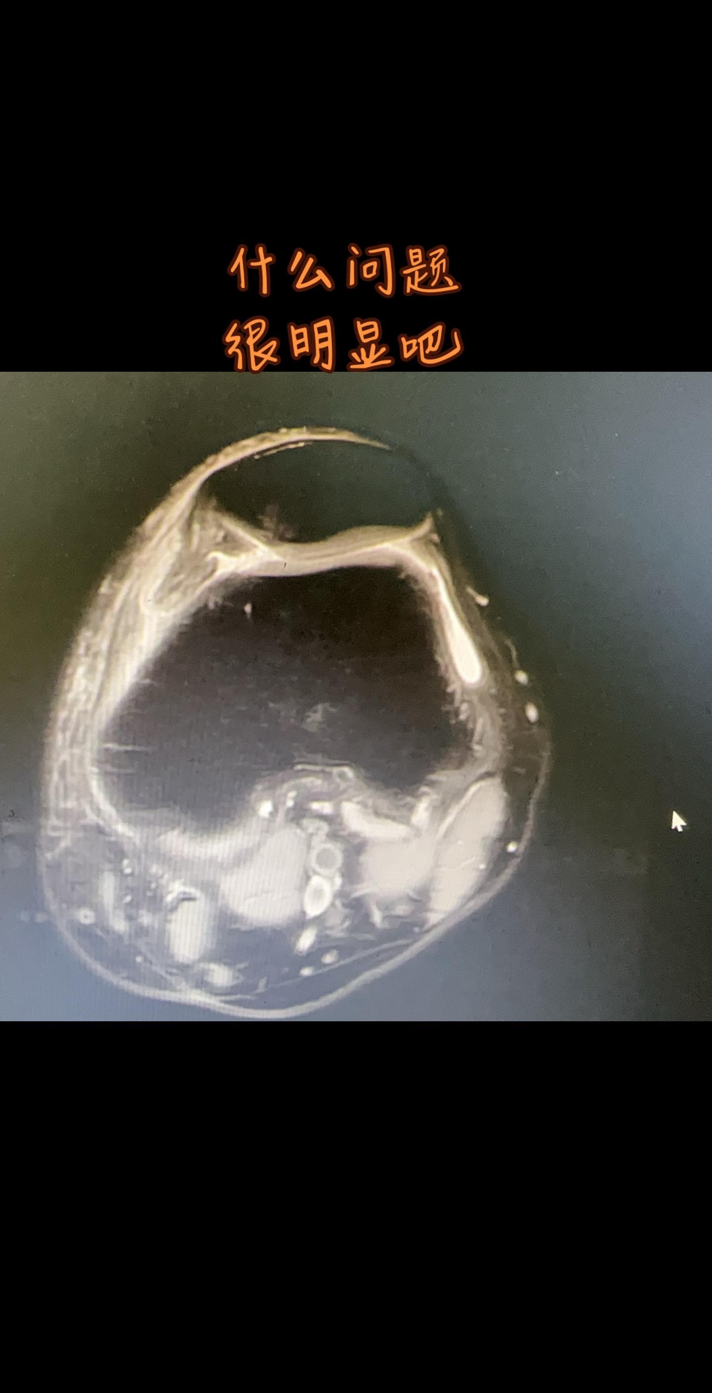 大家一起来阅片。核磁阅片练习