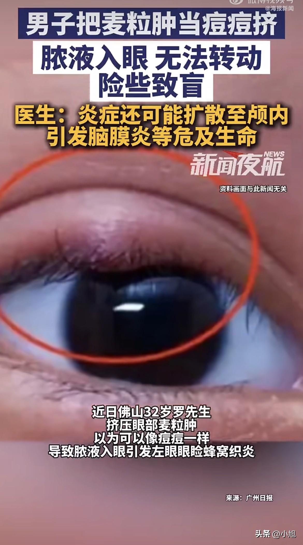 佛山的罗先生，左眼长了个麦粒肿，有点红有点肿。洗脸的时候他对着镜子瞅了瞅，越看越