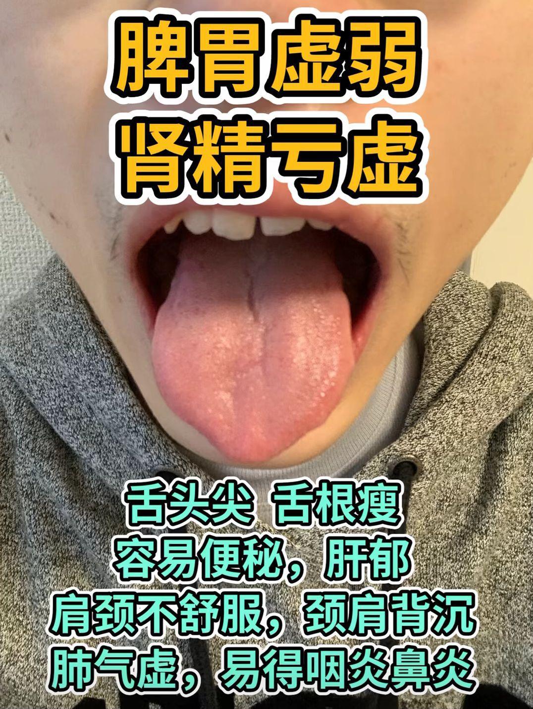 脾胃好不好 看看就知道 对照自己的舌象看一看