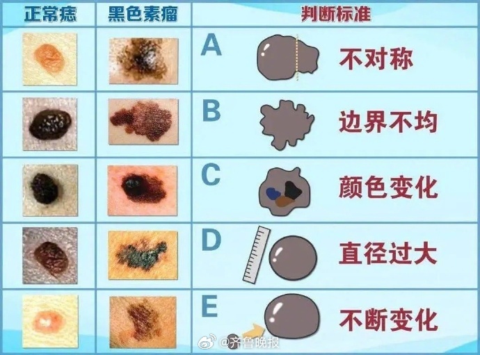 #日常实用大全#【[话筒]#会癌变的痣一般有5个特征#】大部分人身上都有“痣”，