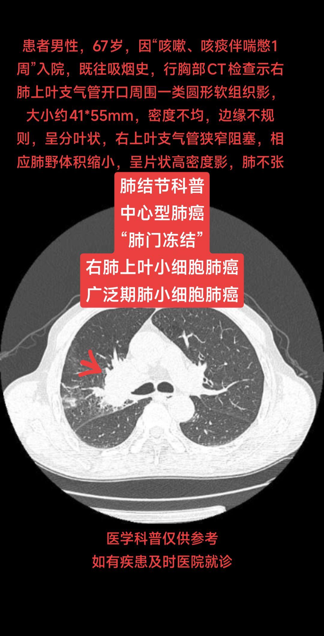 肺结节科普支气管镜检查并活检 患者男性，67岁，因“咳嗽、咳痰伴喘憋1...