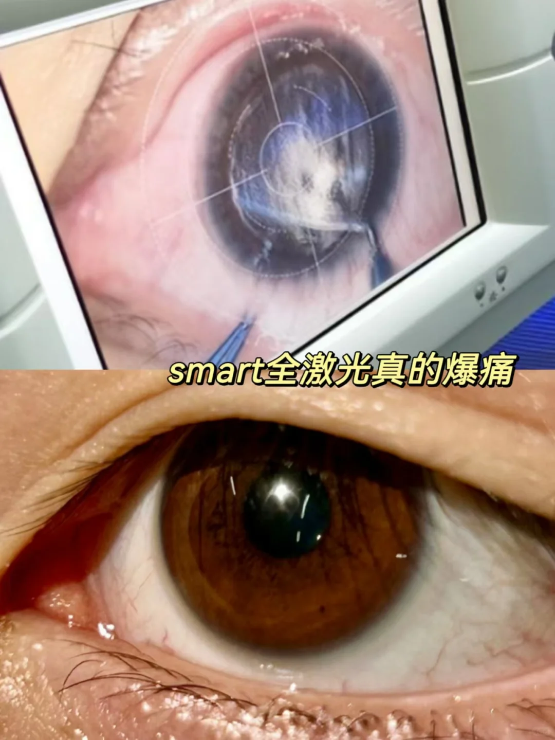 谁说smart全激光不是近视手术爆雷