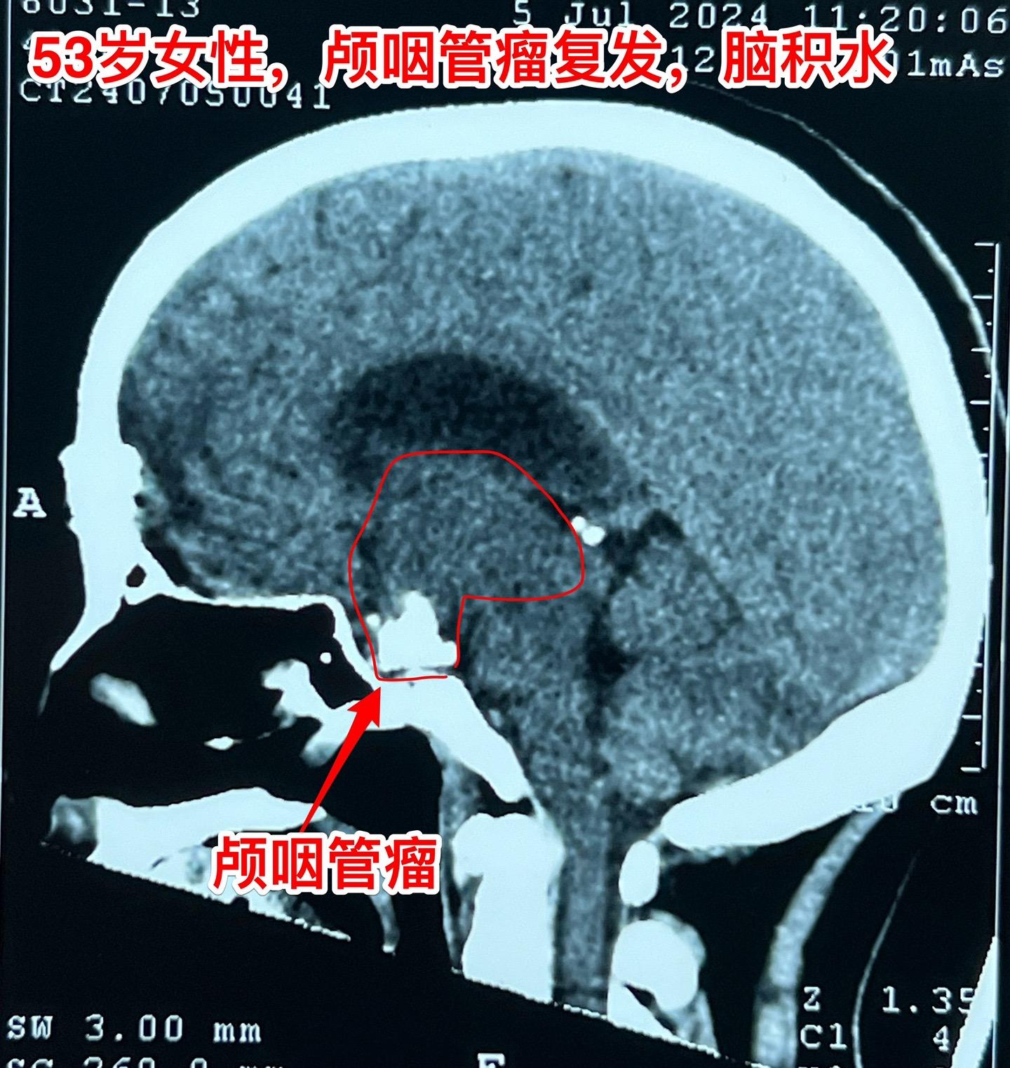 颅咽管瘤复发了怎么就意识混乱了？安徽省宿州的女性，53岁，14年前曾经...